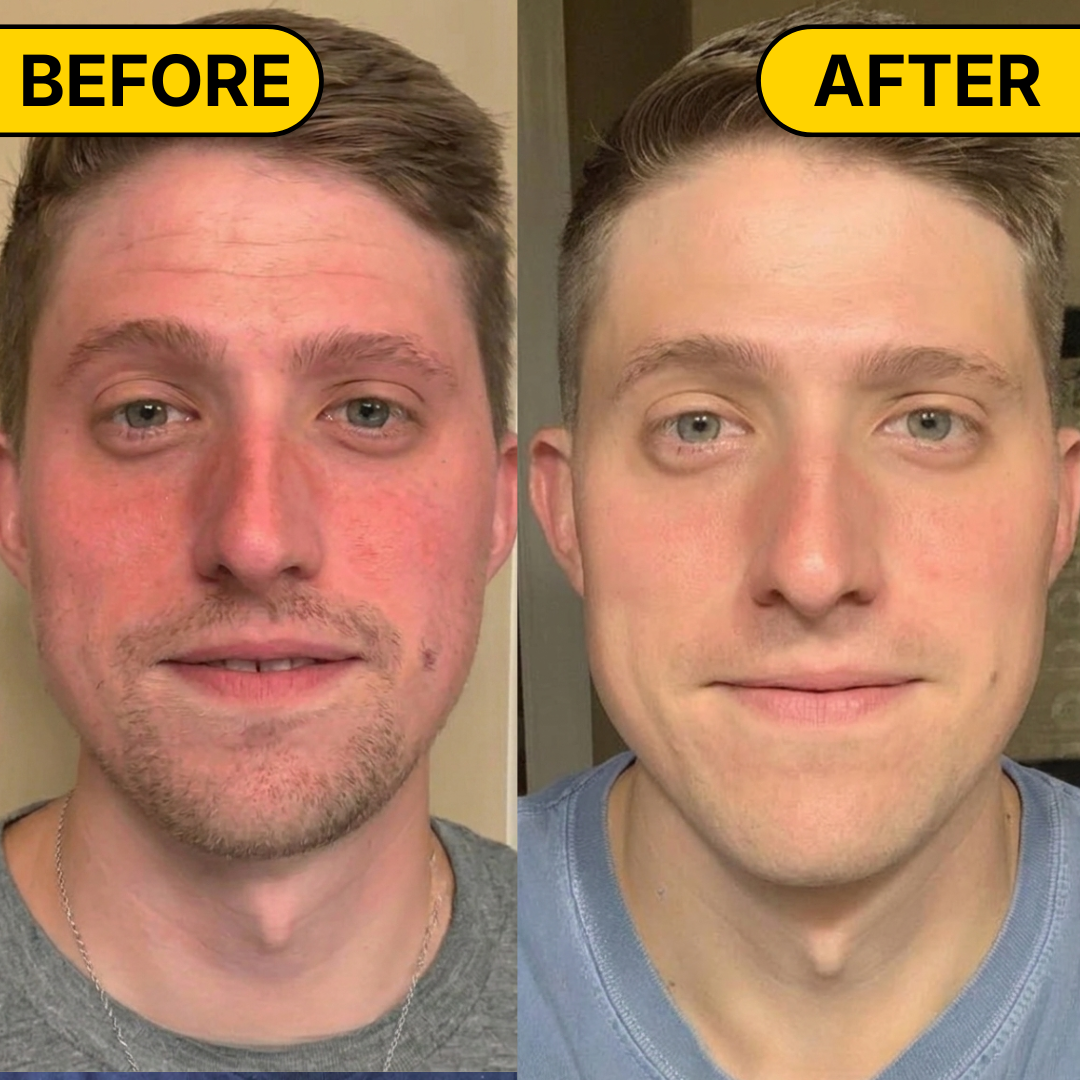 Acne Killer Balm
